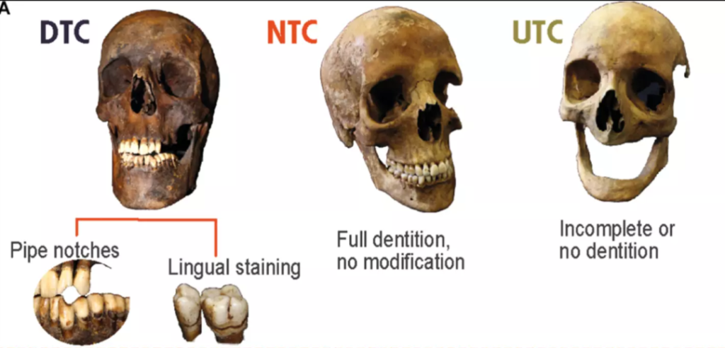 Bone Damage from Smoking: Says a study.